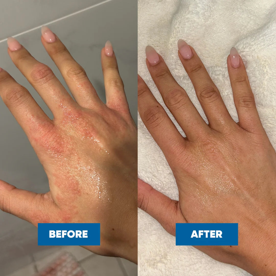 Cradle Cap Scalp Cream