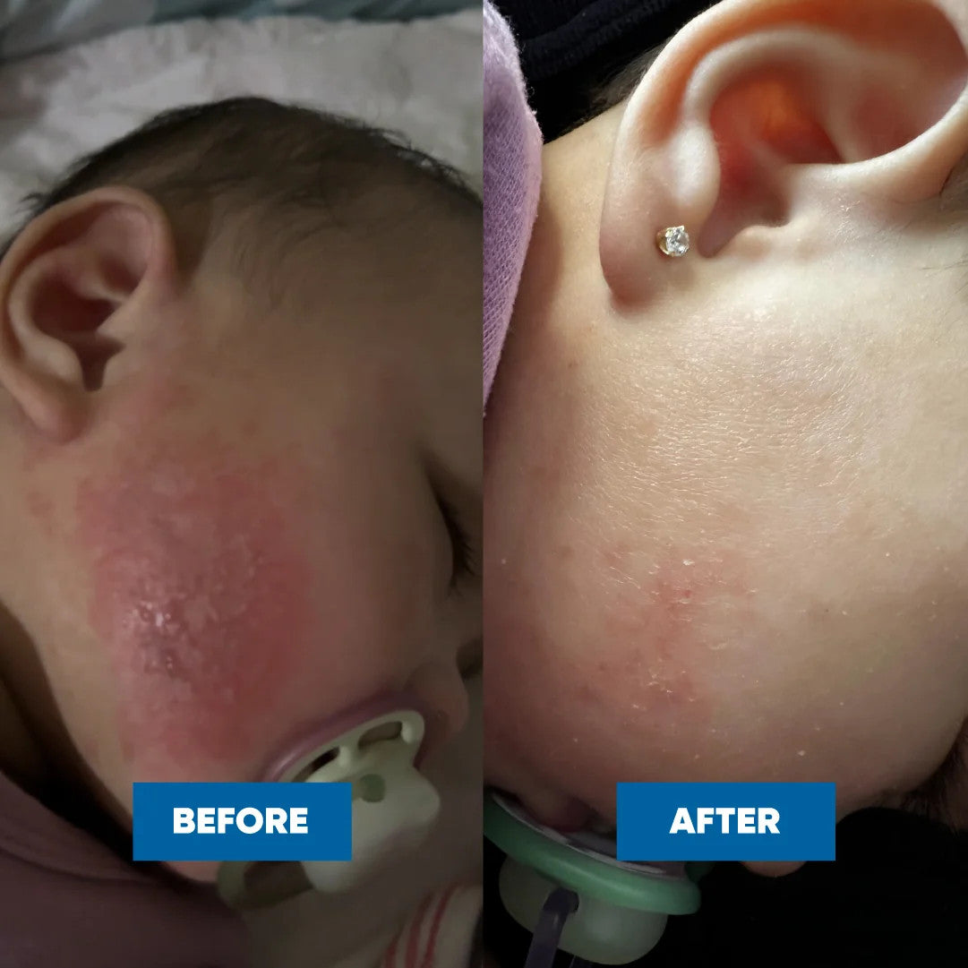 Eczema & Psoriasis Cream