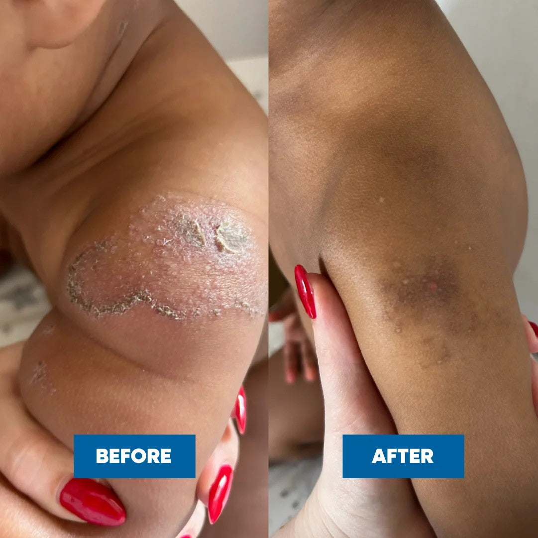 Eczema & Psoriasis Cream