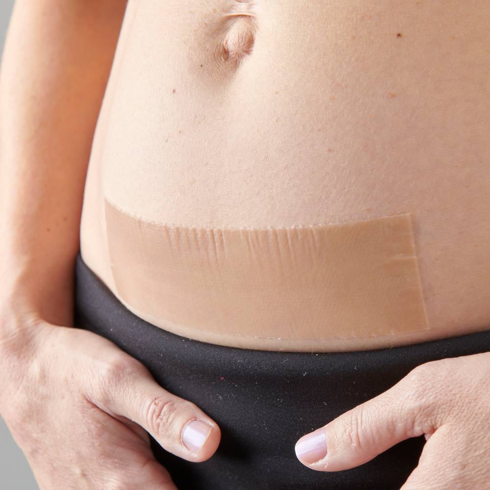 Myscar patch being used on stomach.