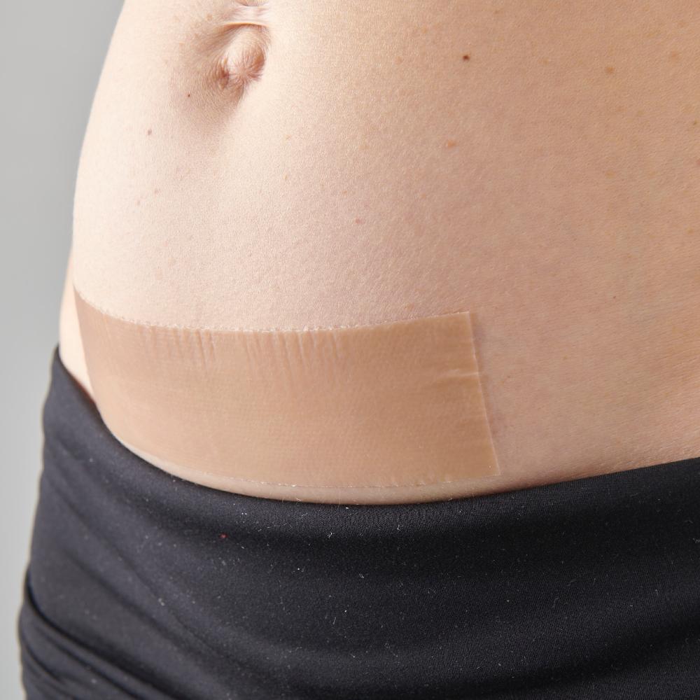 Myscar patch being used on stomach.