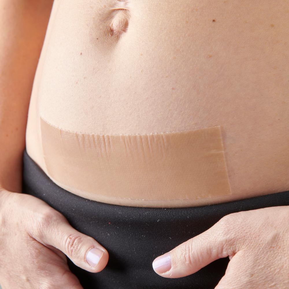 The Original Caesarean Silicone Strips